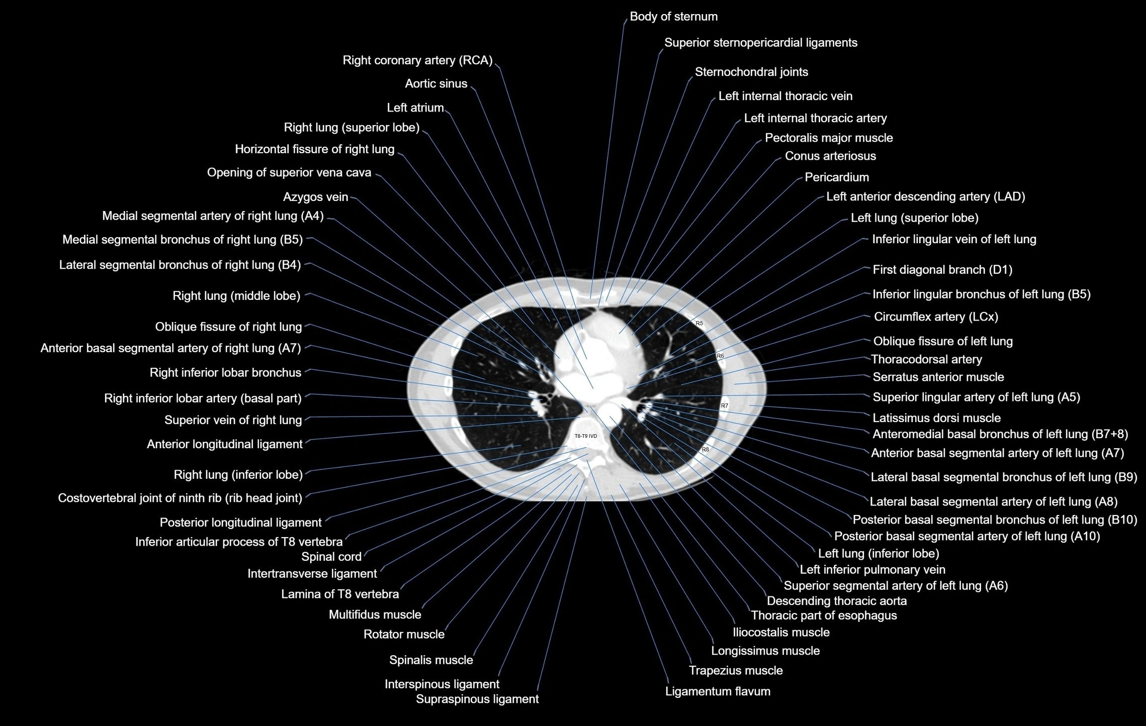 CT chest (thorax) labelled axial cross sectional anatomy radiology image-00069.webp